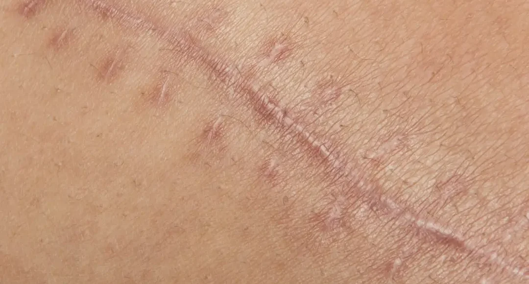 Como quitar cicatrices por dermatologo