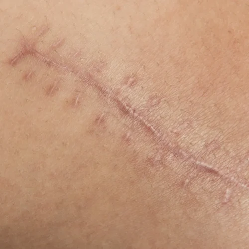 Como quitar cicatrices por dermatologo