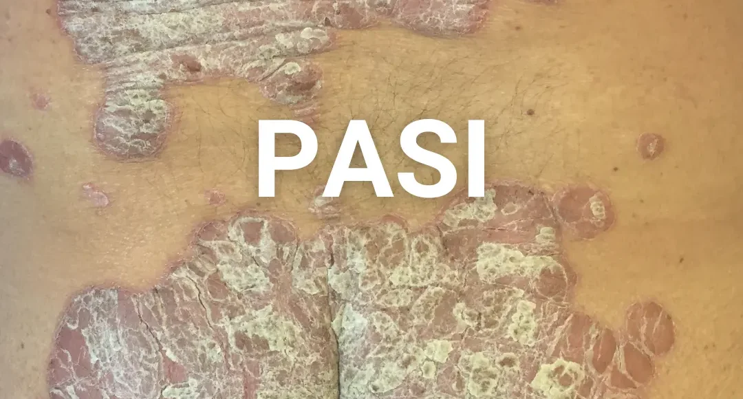 Pasi en psoriasis por dermatologo