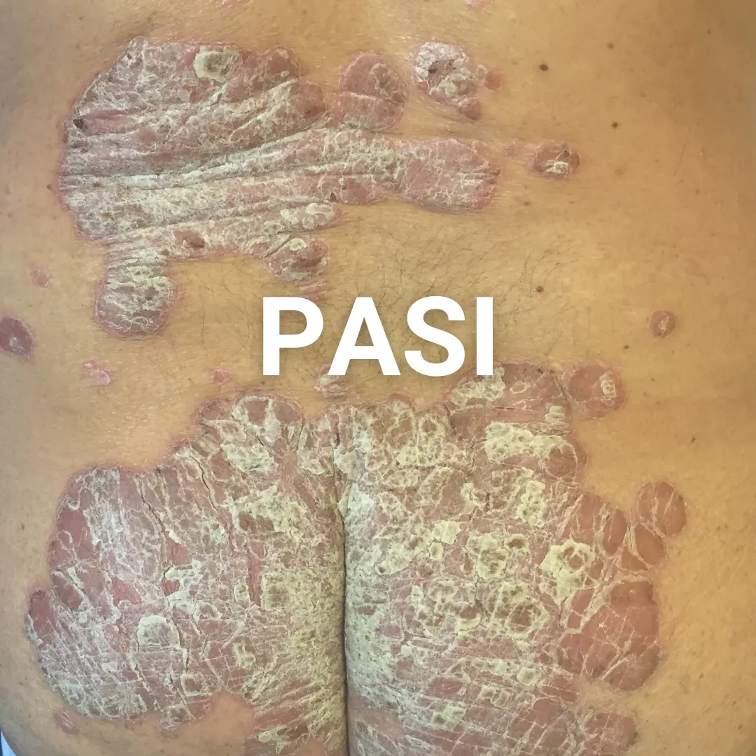 Pasi en psoriasis por dermatologo