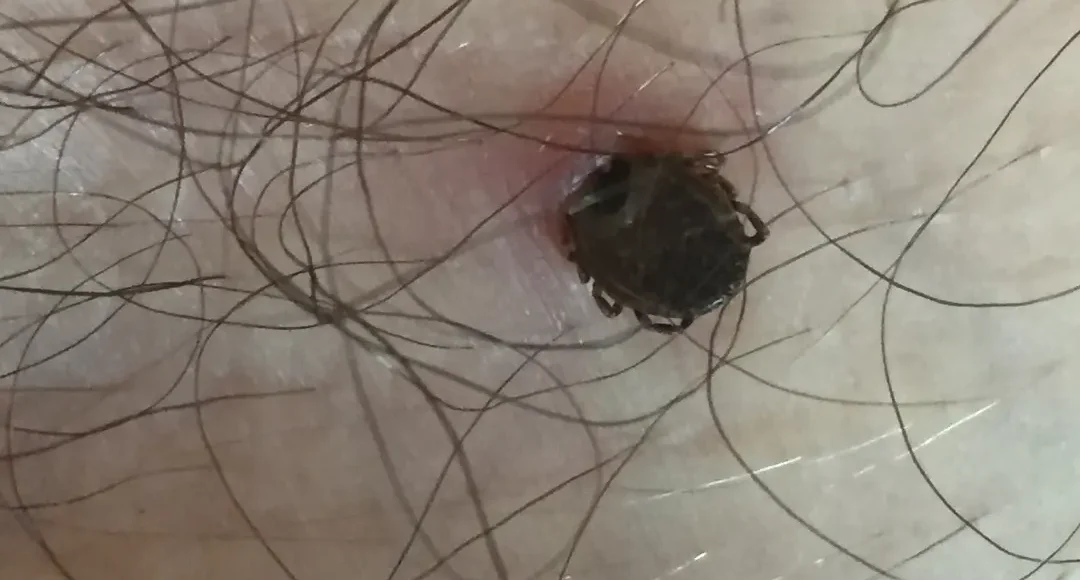 Picadura de garrapata por dermatologo