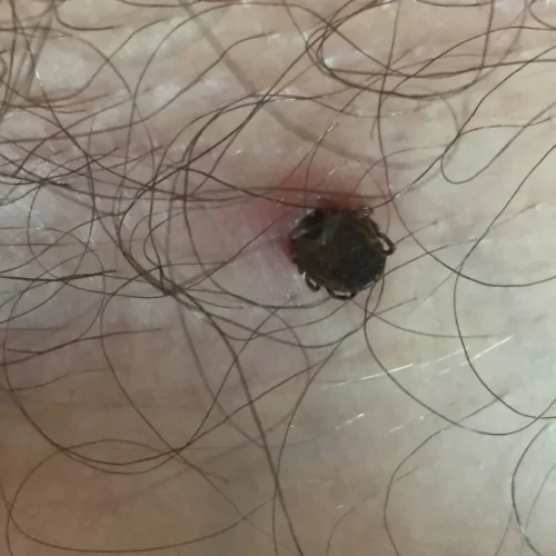 Picadura de garrapata por dermatologo