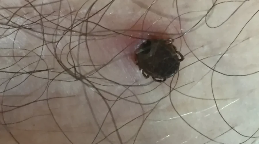 Picadura de garrapata por dermatologo